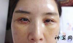 割眼袋影响面相风水吗(割眼袋影响面相风水吗女)