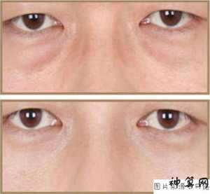 男人眼袋风水(男人眼袋面相)