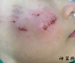 孩子摔伤破相风水(小孩摔破相)