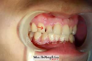 做梦梦到牙齿蛀了洞什么意思(做梦梦到牙齿蛀了洞)