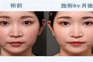 人中长痘痘什么原因(人中)