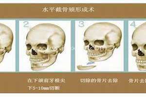 颏裂下巴产生的原因 颏裂下巴是显性遗传