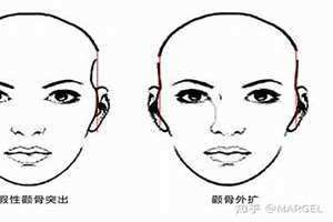 颧骨外扩手术多少钱 颧骨外扩是怎么造成