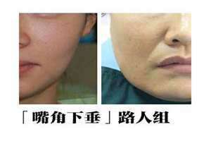 嘴角下垂做什么微整 嘴角下垂叫什么纹