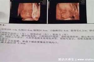 b超单3个数据看男女准吗 b超单3个数据看男女双顶径