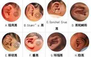 什么样的耳朵是畸形