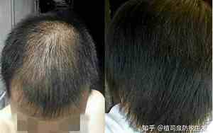 头顶头发稀少还能恢复吗