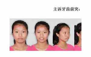 口腔正畸面相照没拍会怎么样