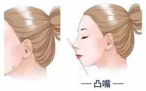 嘴巴前突的女人面相