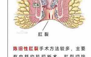 从面相能看出肛裂吗女