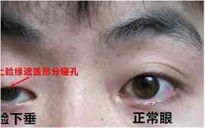 眼睛内陷的人有什么说法