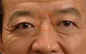 鼻子根部塌陷面相