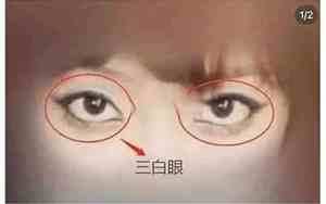 眼睛白翳的症状