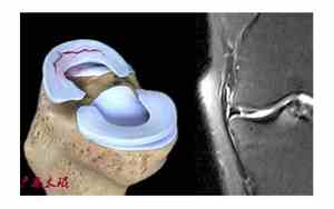半月板损伤三度保守治疗最佳方案