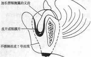 唇颊沟太深